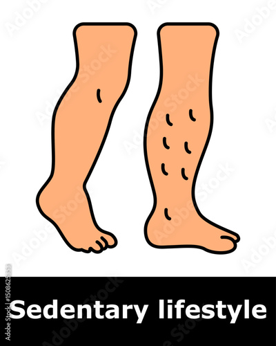 Sedentary icon. Legs with varicose veins due to poor circulation from long periods of sitting.