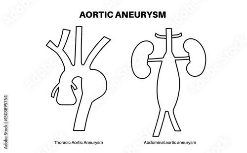 Aortic Aneurysm Types