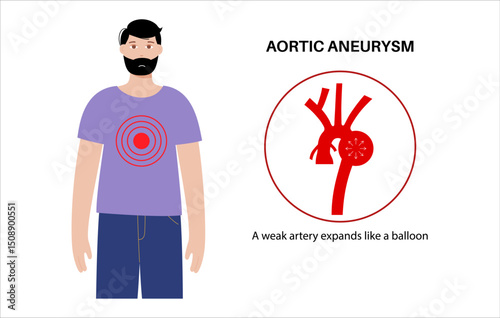 Thoracic aortic aneurysm