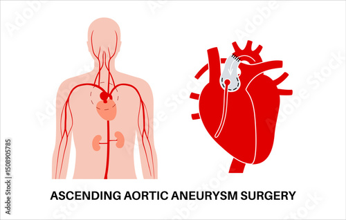 Thoracic aortic aneurysm open surgery