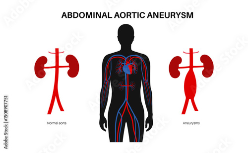 Abdominal Aortic Aneurysm