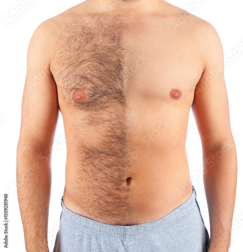 Man Showing Before And After Chest Hair Removal Treatment