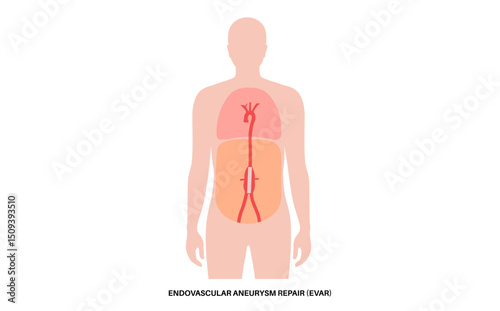 Abdominal Aortic Aneurysm