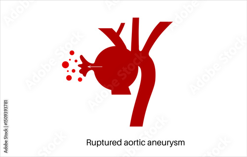 Ruptured thoracic aortic aneurysm