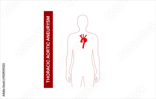 Thoracic aortic aneurysm