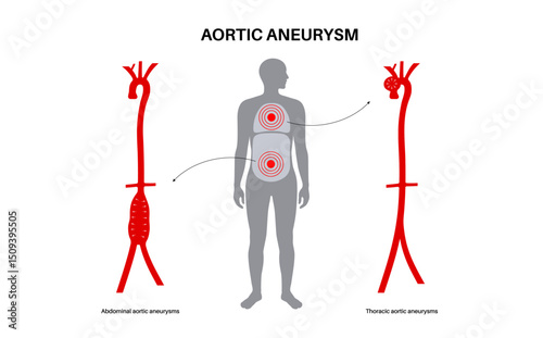 Abdominal Aortic Aneurysm