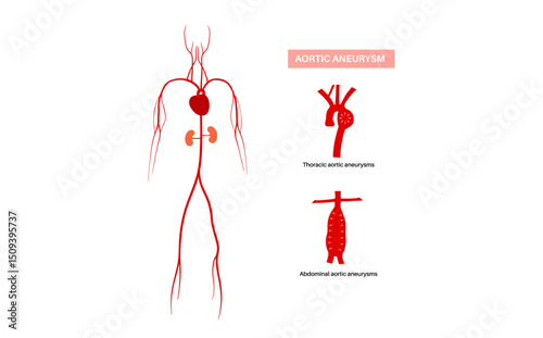 Abdominal Aortic Aneurysm