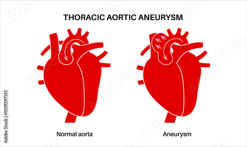 Thoracic aortic aneurysm