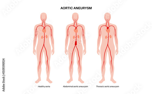 Abdominal Aortic Aneurysm