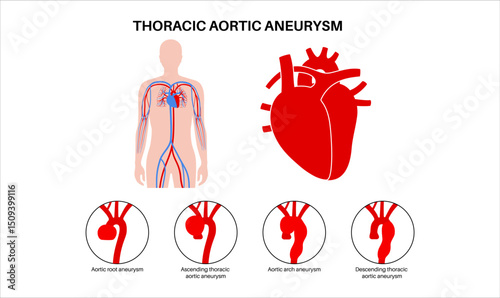 Thoracic aortic aneurysm