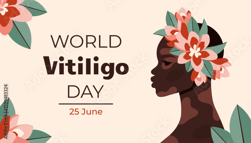 World vitiligo day. Young beautiful black woman with vitiligo patches. African American girl with plumeria flowers. Diversity and support concept. Portrait art. Vector cartoon flat Illustration