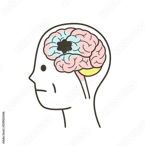 脳血管性認知症によって損傷を受ける脳の部分のイラスト