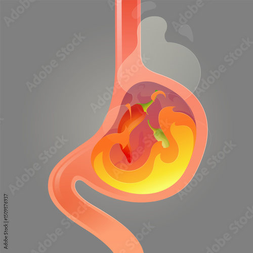 A fiery stomach inflamed by chili a striking image of how spicy food can trigger acid reflux.