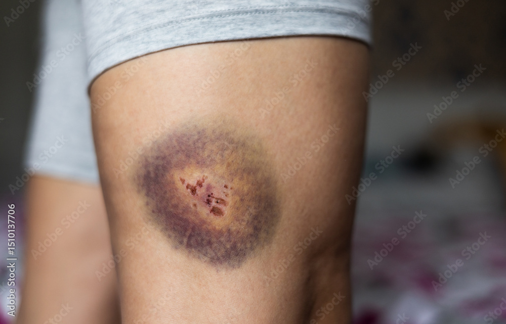 Naklejka premium Large bruise and wound on the leg