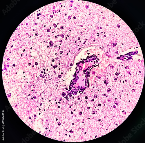 Highly magnified view of brain tumor. Oligodendroglioma of the brain. Brain glioma. Histological slide under microscopy. 