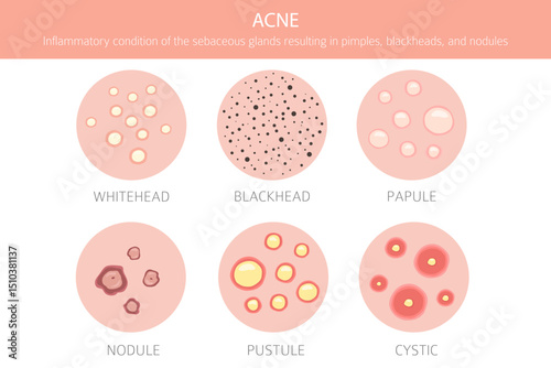 Acne skin condition. Skin diseases. Medical infographic design. Vector illustration