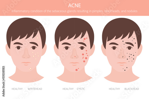 Acne skin condition. Skin diseases. Medical infographic design. Vector illustration