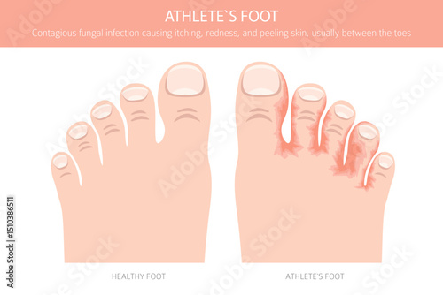Athlete`s foot. Tinea pedis skin condition. Skin diseases. Medical infographic design. Vector illustration