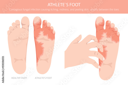Athlete`s foot. Tinea pedis skin condition. Skin diseases. Medical infographic design. Vector illustration