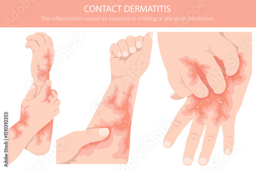 Contact dermatitis. Skin diseases. Medical infographic design. Vector illustration