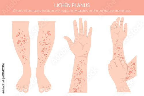 Lichen Planus. Skin diseases. Medical infographic design. Vector illustration