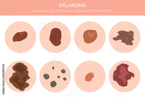 Melanoma. Skin diseases. Medical infographic design. Vector illustration