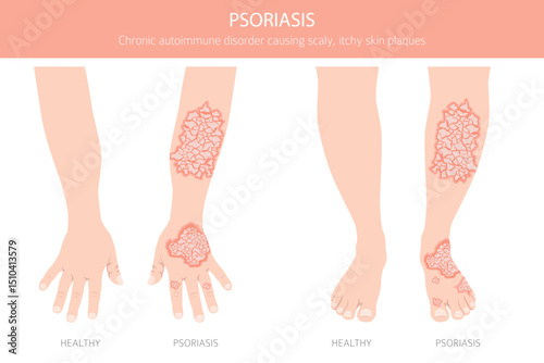 Psoriasis. Skin diseases. Medical infographic design. Vector illustration