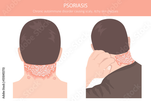 Psoriasis. Skin diseases. Medical infographic design. Vector illustration