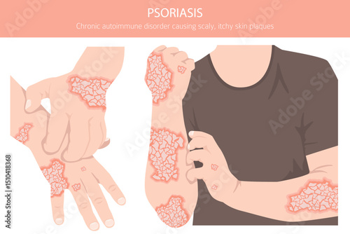 Psoriasis. Skin diseases. Medical infographic design. Vector illustration