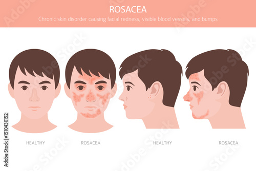 Rosacea. Skin diseases. Medical infographic design. Vector illustration