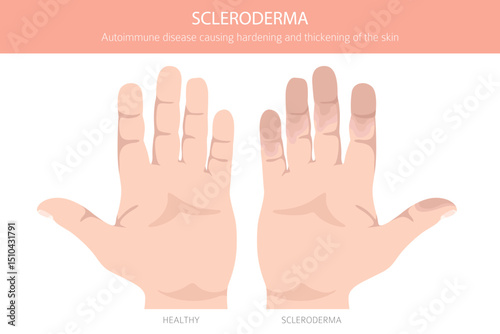 Scleroderma. Skin diseases. Medical infographic design. Vector illustration