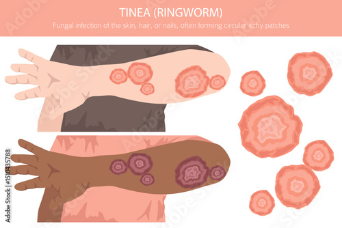 Tinea. Ringworm. Skin diseases. Medical infographic design. Vector illustration