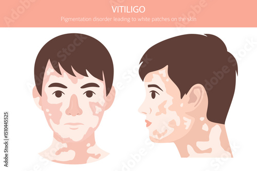 Vitiligo. Skin diseases. Medical infographic design. Vector illustration