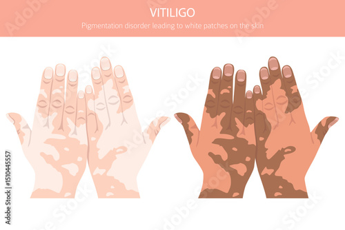 Vitiligo. Skin diseases. Medical infographic design. Vector illustration