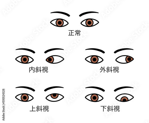斜視の種類（内斜視、外斜視、上斜視、下斜視）のイラスト