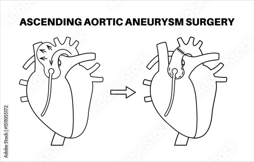Thoracic aortic aneurysm open surgery