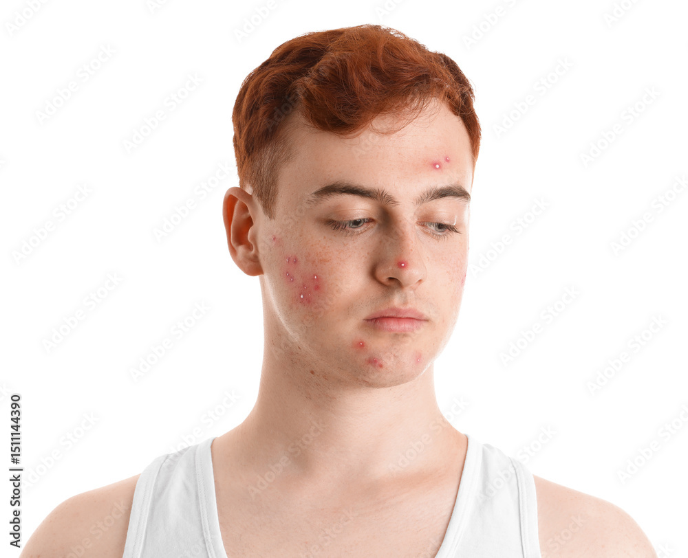 Obraz premium Teenage boy with acne on white background