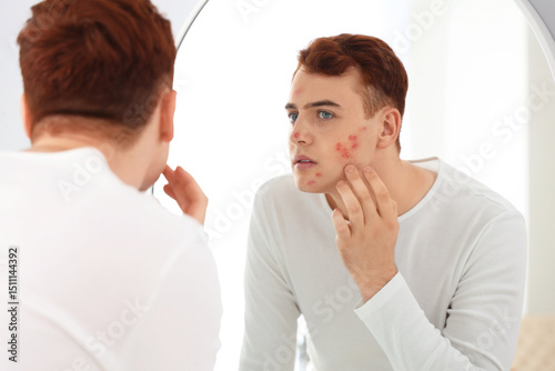 Teenage boy with acne looki...