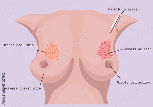 Inflammatory breast carcinoma (IBC) is a rare and aggressive form of breast cancer characterized by rapid onset of redness, swelling, warmth, and skin changes resembling an orange peel texture.