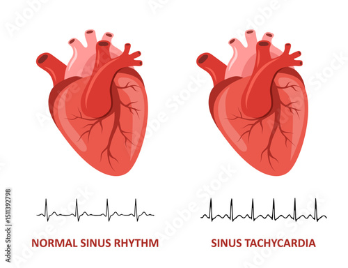 Heart diseases. Normal sinus rhythm and Sinus Tachycardia. Medical check up. Vector illustration in flat cartoon style.