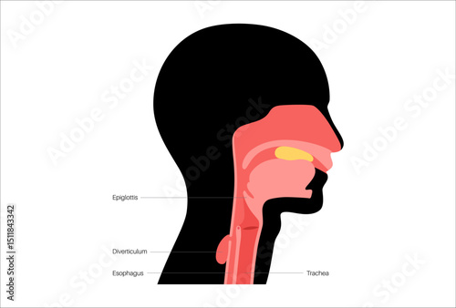 Pharyngoesophageal diverticulum poster