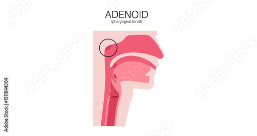 Adenoid medical poster