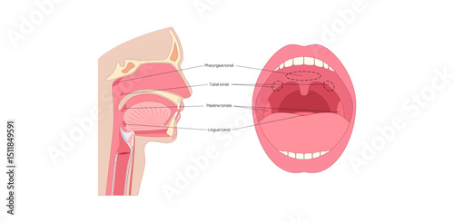 Adenoid medical poster