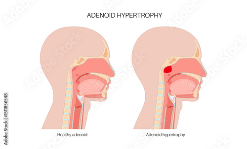 Enlarged adenoids poster