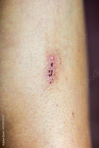 A serious blistering skin condition on the arm needing medical attention and care