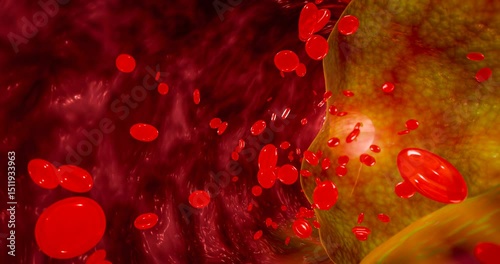 Blocked artery filled with accumulation of fat, cholesterol plaques, blood clots, unhealthy foods, and sugary beverages, illustrating risks of heart disease, stroke, and vascular damage. 3D rendering.