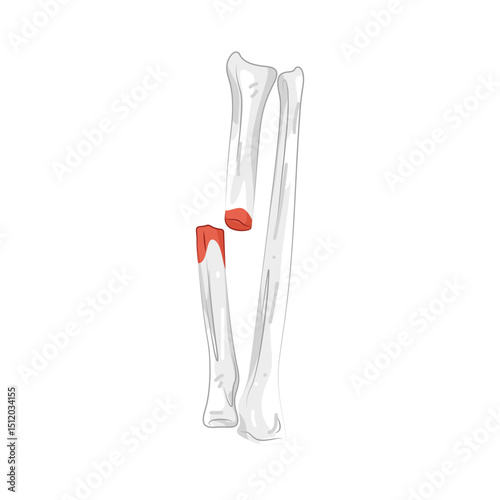 Illustration of fracture