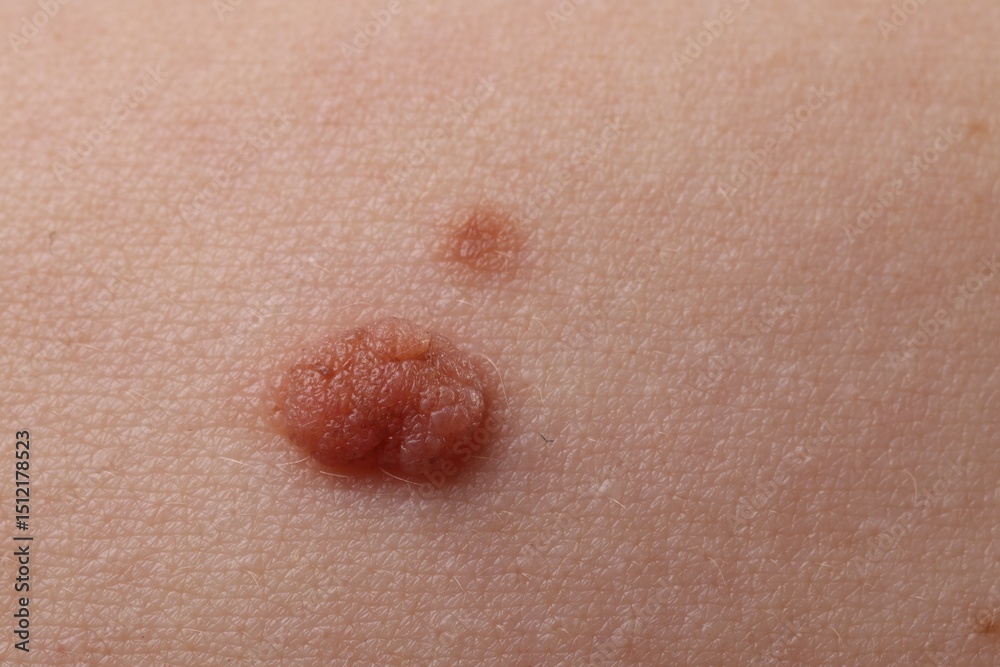 Fototapeta premium Woman with moles on her body, closeup