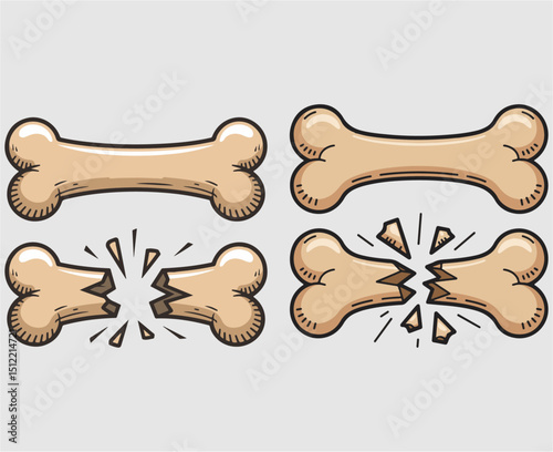  Broken or Fractured Bone