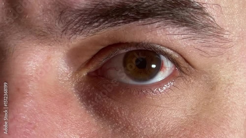 Horizontal video close up. Open male eye with burst capillaries, blood near brown iris, redness. White man blinks, looks around. Lack of sleep, vision disease, health, pain, allergy, illness, stress